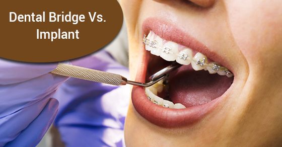 Dental Bridge vs. Implant: What’s the Difference?