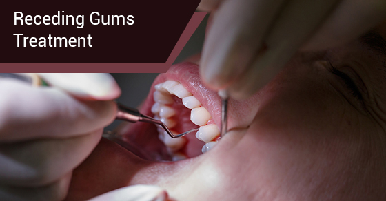 receding gums treatment
