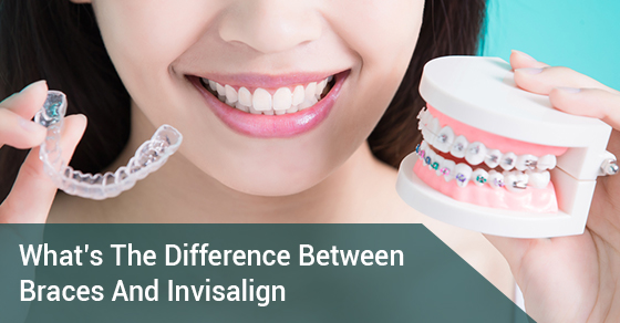 What’s The Difference Between Braces And Invisalign