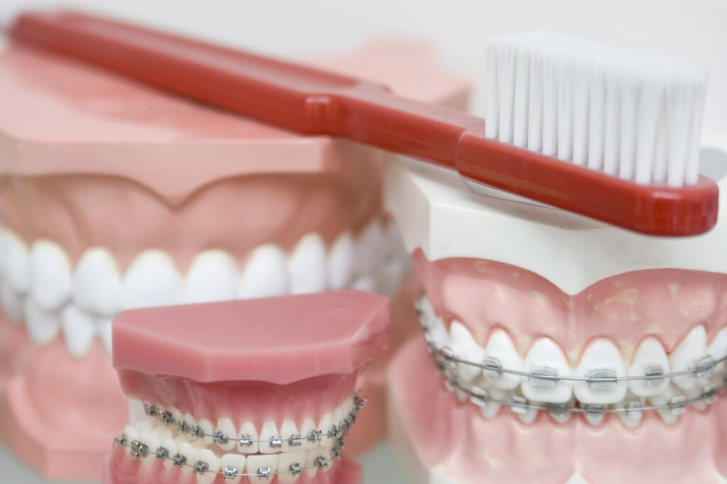 What Is the Best Toothbrush for Braces?