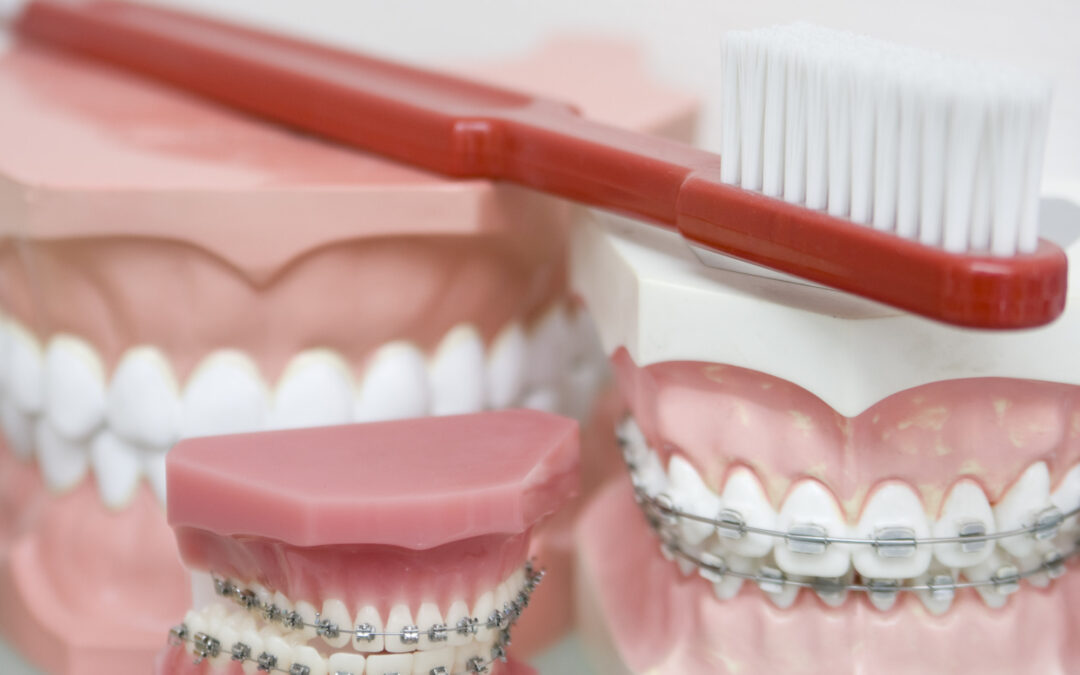 What Is the Best Toothbrush for Braces?
