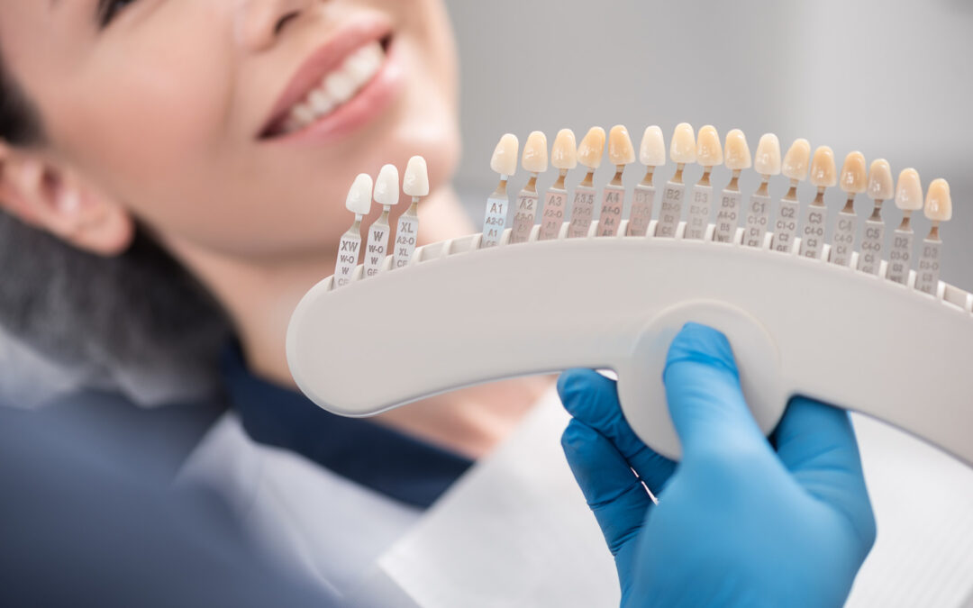 Dental Veneers vs Dental Crowns: What’s the Difference?