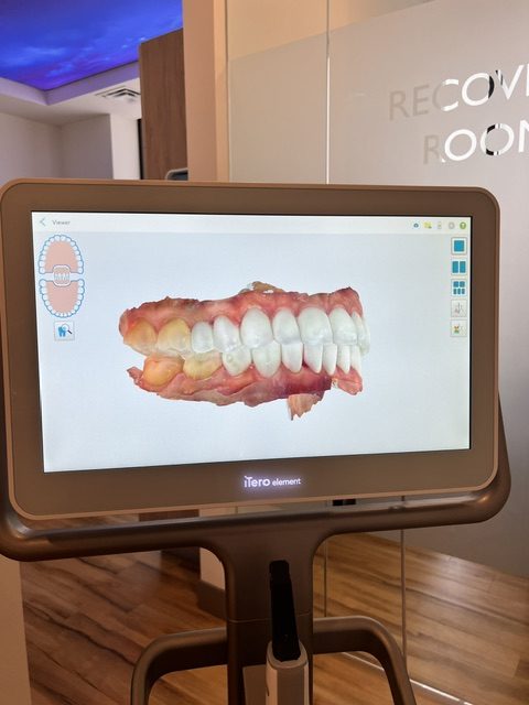 iTero digital scanner at Willow Dental